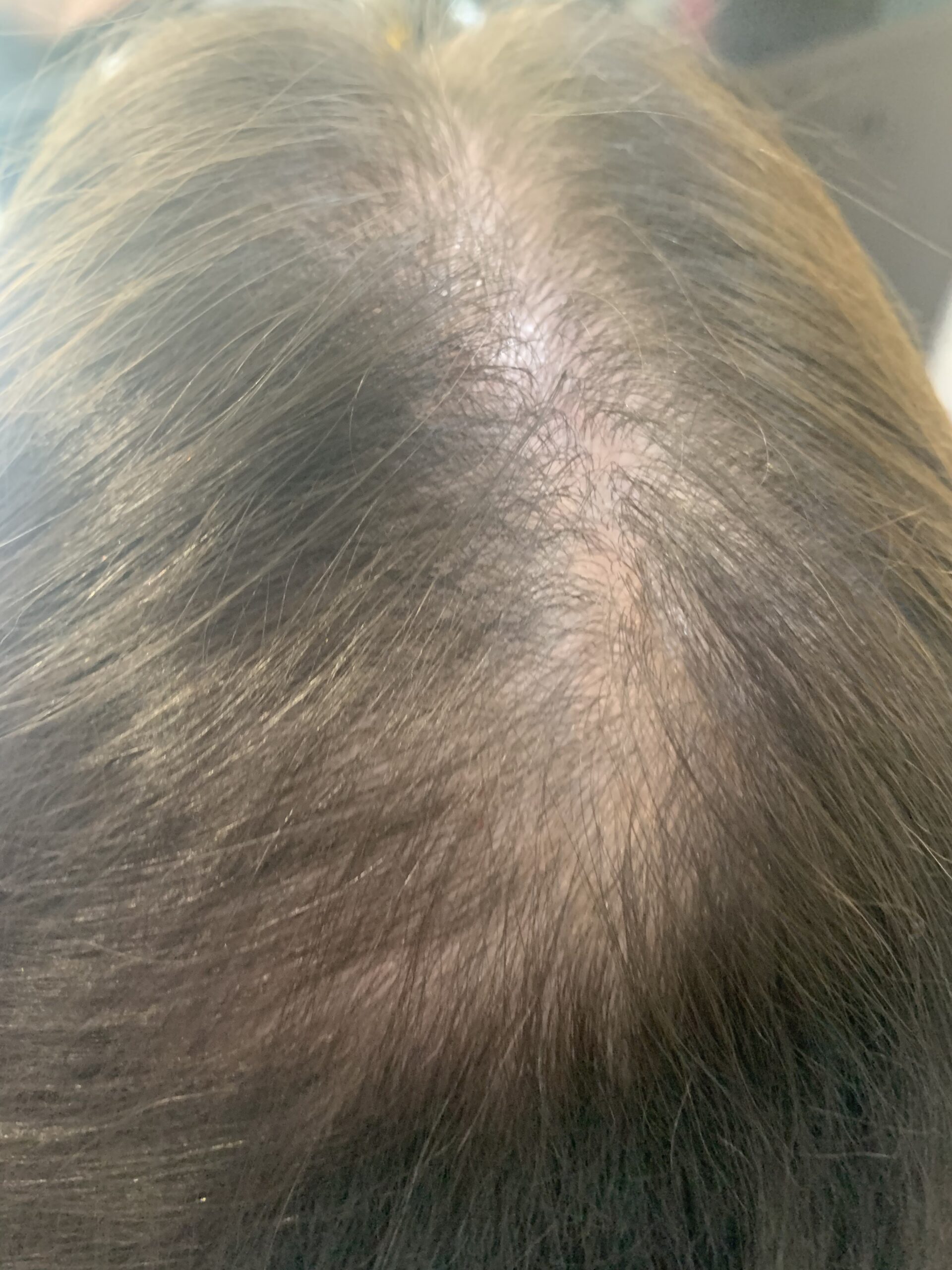 Queda de Cabelo no Tatuapé | Tratamento Eficaz no Jack Oliveira Queda de Cabelo no Tatuapé | Tratamento Eficaz no Jack Oliveira