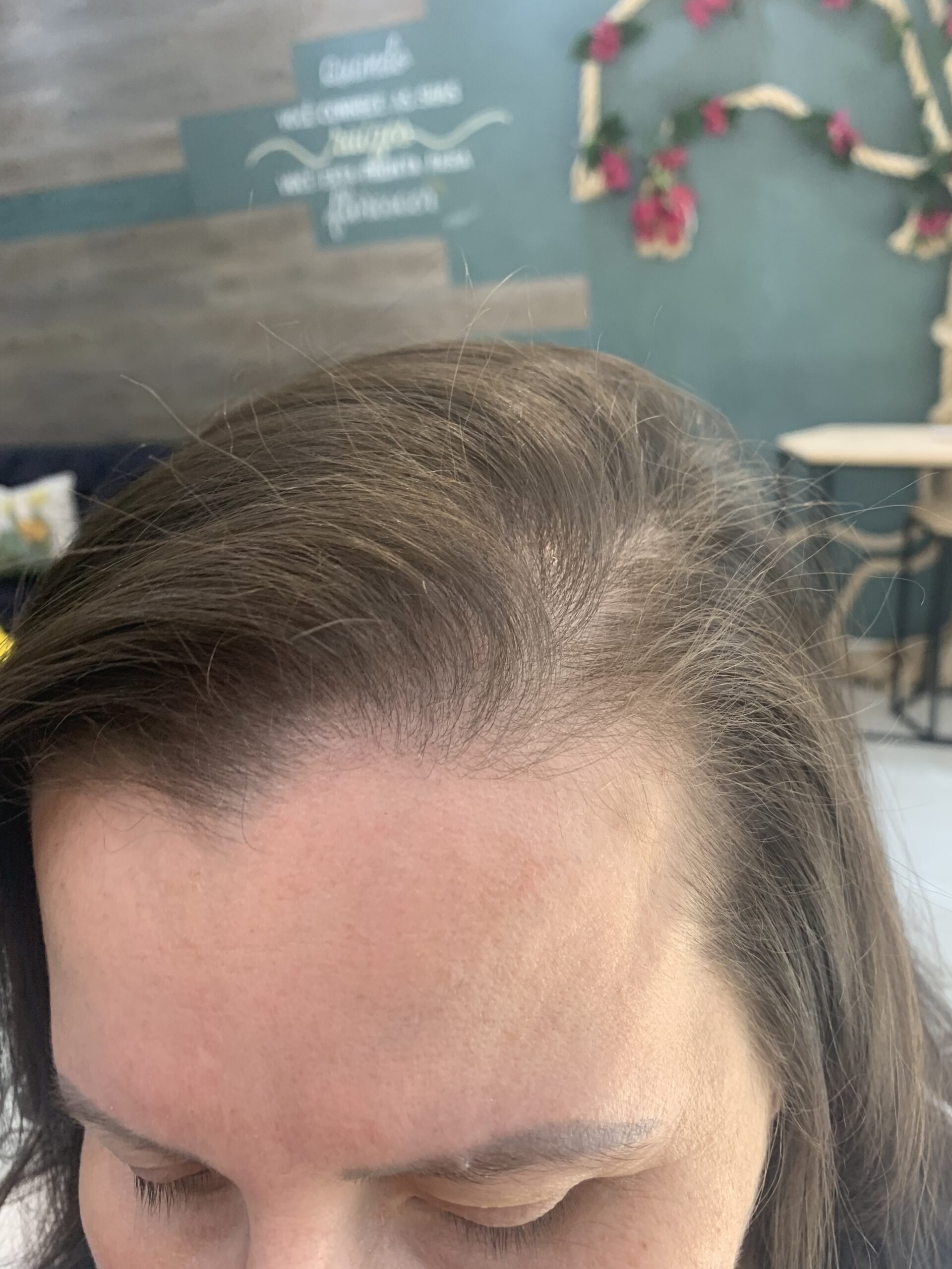 Queda de Cabelo no Tatuapé | Tratamento Eficaz no Jack Oliveira Queda de Cabelo no Tatuapé | Tratamento Eficaz no Jack Oliveira
